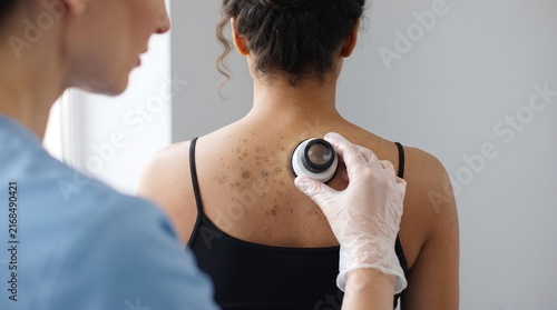 Dermatologist using dermatoscope to examine multiple atypical moles on female patient back for skin cancer screening