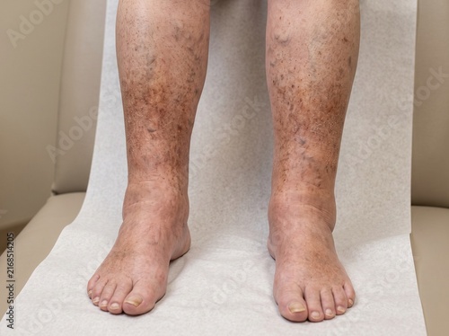 Bilateral Chronic Venous Edema and Stasis Skin Changes in Elderly Legs