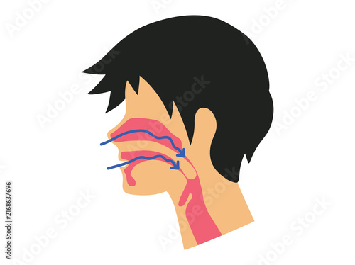 OSA and Complete Obstruction of the Airway during Sleep
