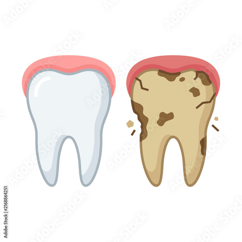 Close-up on teeth erosion from smoking and healthy tooth comparison  