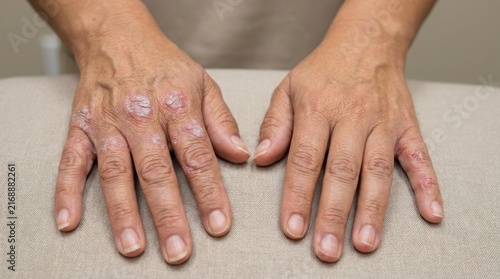 Close up of human hands showing signs of skin condition like psoriasis or eczema