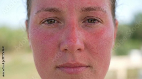 Close up of a woman's face with severe sunburn showing red skin and irritation on cheeks nose and forehead