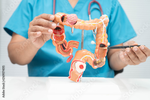 Konstfotografi Colorectal cancer, doctor holding intestine colon human anatomy model