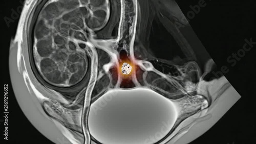 Kidney Stone CT Visualization of Layered Urinary Tract Anatomy for Detailed Medical Analysis and Diagnostic Insight