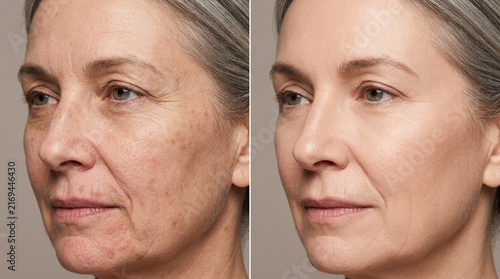 Aging Skin Transformation Before & After Wrinkles, Spots, and Texture Improvement