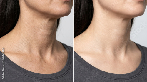 Before and After Neck Wrinkles Treatment | Anti-aging Skin Care Comparison