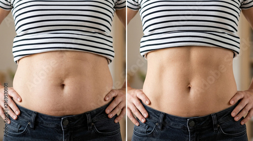 Before and After Weight Loss: Woman's Stomach Comparison, Slimming Down