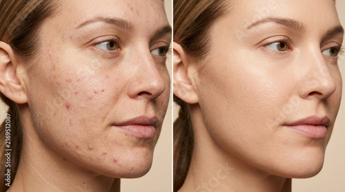 Before and After Skincare: Acne Scar Removal, Flawless Skin Transformation