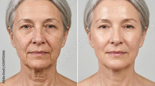 Mature Woman Before and After Skincare Treatment, Anti-Aging, Skin Rejuvenation