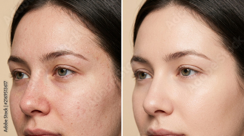 Before and After Skincare: Woman's Face with Imperfections vs. Smooth Skin