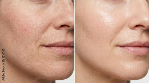 Before and After Skincare: Wrinkles vs Smooth Skin, Anti-Aging Effect