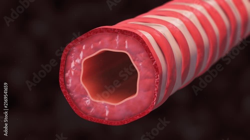 Bronchiole Constriction Causing Narrowed Airways and Restricted Airflow