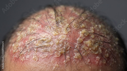 Extreme macro of severe scalp seborrheic dermatitis with thick yellow crusty scales and inflamed hair roots