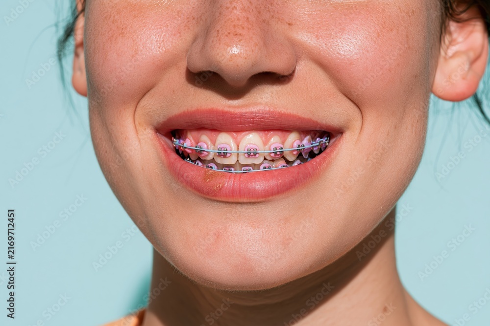 Fototapeta premium Smiling mouth of a young person with orthodontic braces and lavender ties, featuring a clean enamel surface and soft lighting for dental care and clinic campaigns