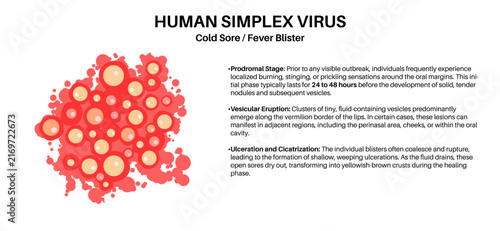 Naklejka Herpes simplex virus HSV1