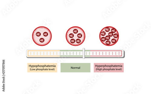 Foto Hyperphosphatemia, high plasma phosphate level and Hypophosphatemia, low plasma phosphate level