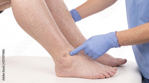Adult Patient with Bilateral Lower Limb Edema Associated with Heart Failure