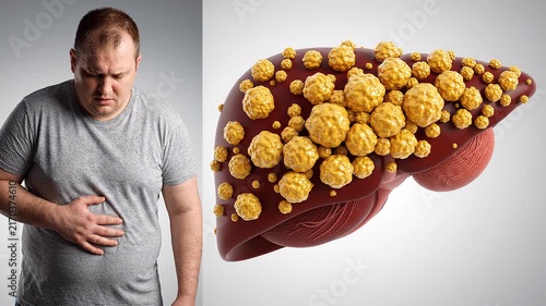Man suffering from abdominal pain with a 3D medical visualization of a diseased liver showing liver cirrhosis progression