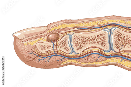 Anatomical illustration of a glomus tumor beneath the fingernail showing a small vascular tumor within the distal finger soft tissue.