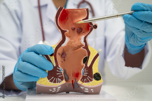 Photography Asian doctor with rectum and hemorrhoid human anatomy model at hospital, inflamed vascular structure