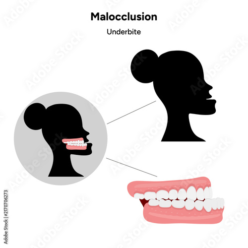 Hand-drawn medical and dental health illustration depicting an underbite, a dental and jaw alignment condition where the lower teeth or jaw extend in front of the upper teeth