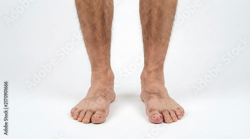 Male Feet with Onychomycosis Fungal Nail Infection and Swollen Inflamed Big Toe