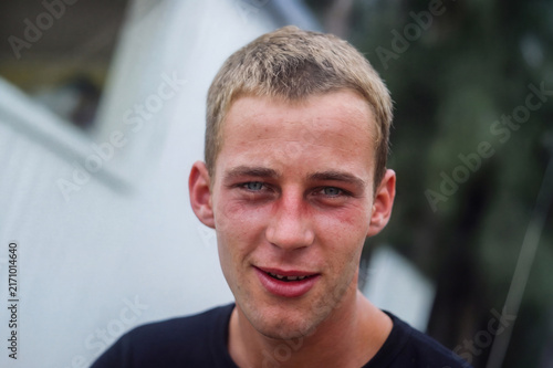 Portrait of a young man with a sunburn on his face