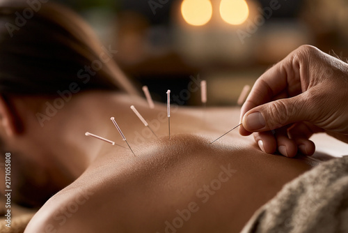 A tranquil scene of acupuncture therapy focusing on relaxation and healing of the body.