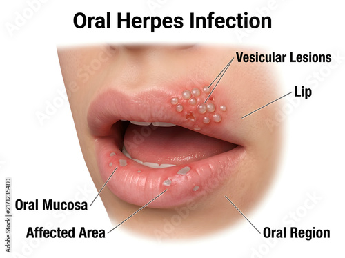Oral herpes infection with vesicular lesions on lip isolated on white background