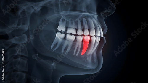 Medical dental digital x-ray of human jaw showing an inflamed tooth