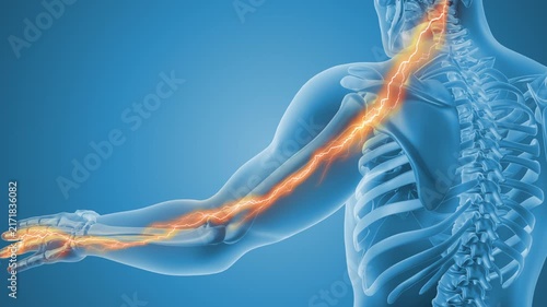 Cervical Nerve Pain Radiating Into Arm
