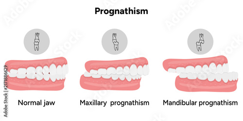 Hand-drawn medical and dental illustration depicting prognathism, including maxillary prognathism and mandibular prognathism