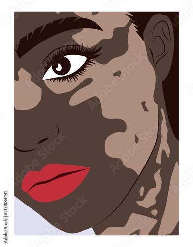 Woman with vitiligo close up portrait