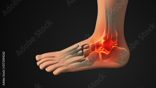 Ankle Injury With Highlighted Painful Joint