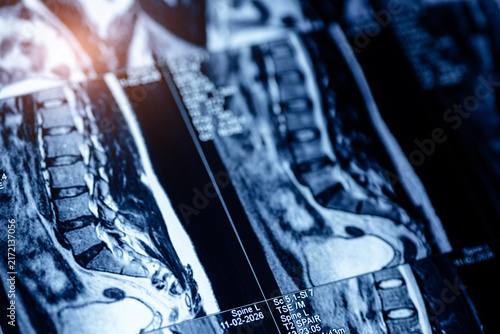 Angled mri lumbar spine sagittal images for medical diagnostic background and educational poster design, closeup macro photo