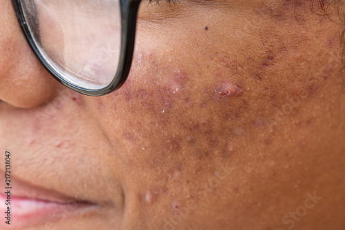 Person with acne and blemishes on face skin