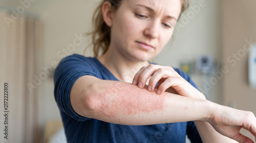 Young woman suffering from itching on her skin and scratching an itchy place. Allergic reaction to insect bites, dermatitis, food, drugs. Health care concept. Allergy rash