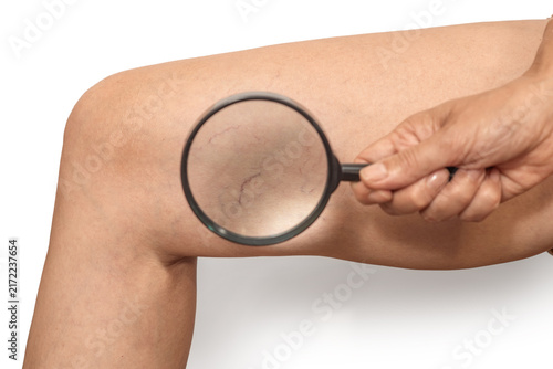 Visible vascular network  on woman's thigh through  magnifying glass. White background, isolated.