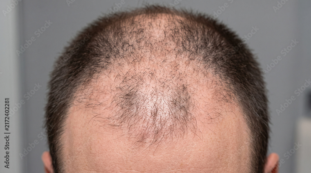 Fototapeta premium Top view of a man's head with sparse strands, widening bald area and progressive recession around the temples, male alopecia, crown thinning, frontal recession, reduced density, follicle loss, balding