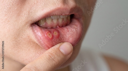 Close-up of painful canker sores and aphthous ulcers on lower inner lip of a person