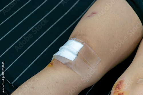 Foto Close view of an injured knee covered gauze medical tape showing bruises minor w