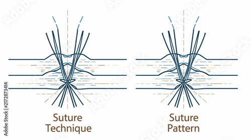 A clean line art illustration demonstrating a surgical suture technique for wound closure, ideal for medical textbooks and healthcare educational materials.