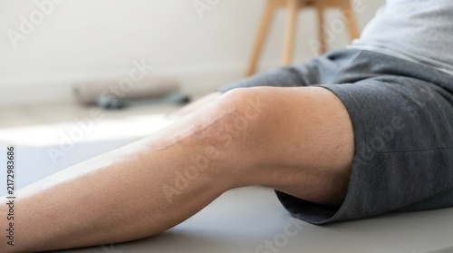 Close-Up of Clean Healed Surgical Scar on Knee After Orthopedic Surgery and Recovery