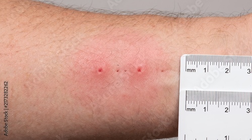 Close up view of skin rash and red marks on the arm with measurement scale