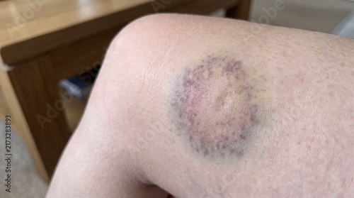 Close up view of skin rash inflammation and redness showing signs of dermatological irritation and patch formation