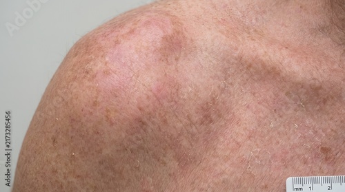Close up view of skin texture and redness on shoulder area showing dermatological condition and fine lines