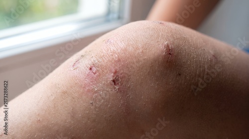 Close up view of skin wounds and healing on leg skin showing rashes and abrasions skin injuries dermatology concerns body pain