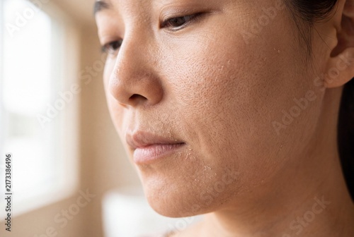 Macro photograph of Asian female skin showing signs of dehydration, rough texture, fine lines, patchy dryness and natural facial pores