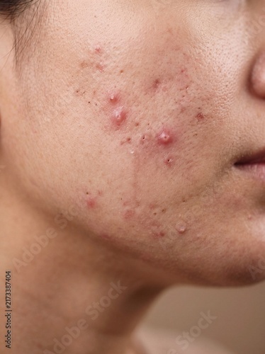 Ultra Realistic Close-Up Portrait of Female Facial Skin Showing Natural Skin Texture and Red Acne Breakouts Requiring Dermatological Care