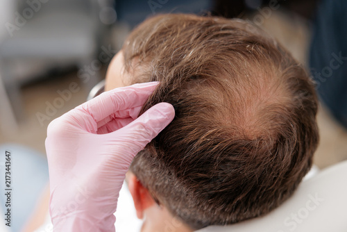 Canvastavla Closeup scalp examination showing male hair loss at clinic with gloved hand for